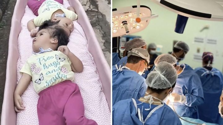 Conjoined twin girls, 2, die in desperate surgical operation minutes after being separated