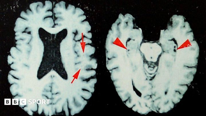 Brain disease in dead NFL players 'higher than previously shown'