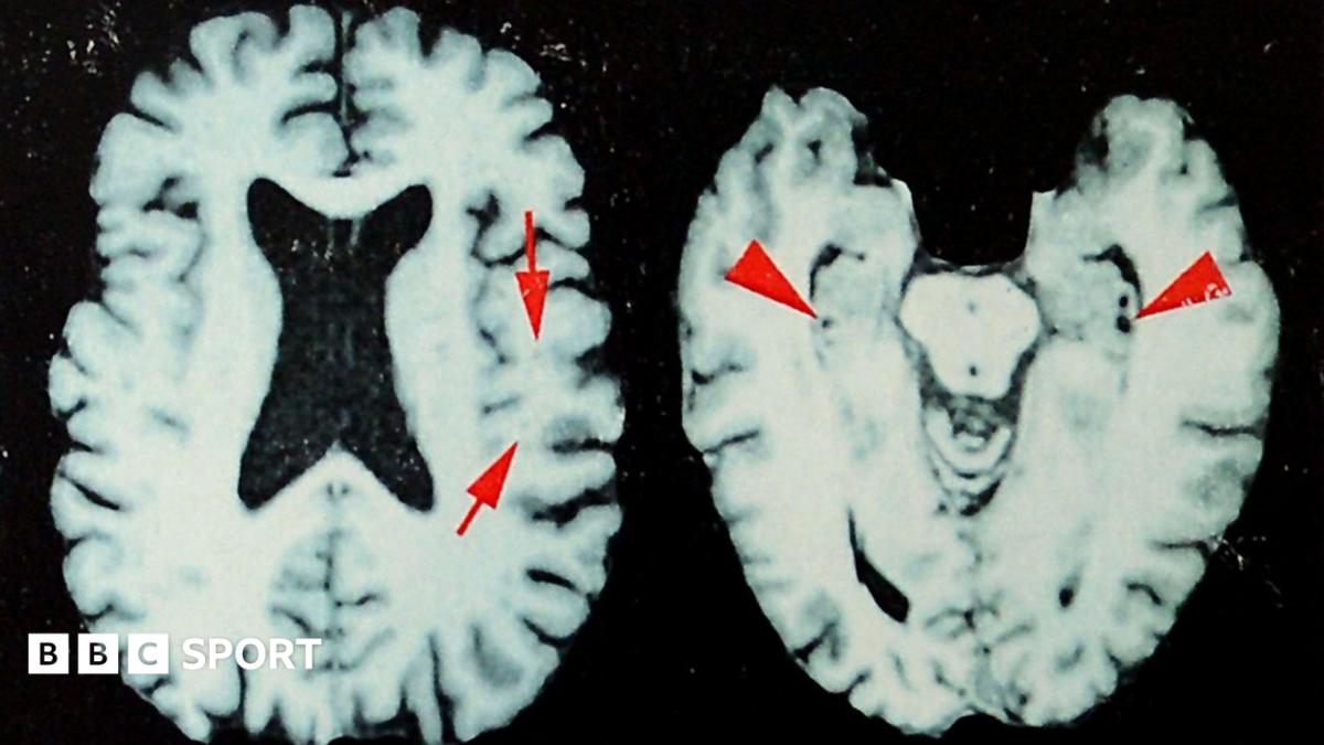 Brain disease in dead NFL players 'higher than previously shown'