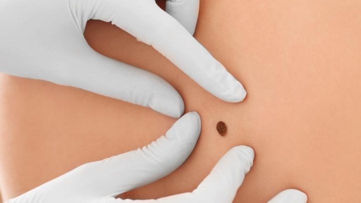 New vaccine prevents deadliest skin cancer from coming back: drugmakers