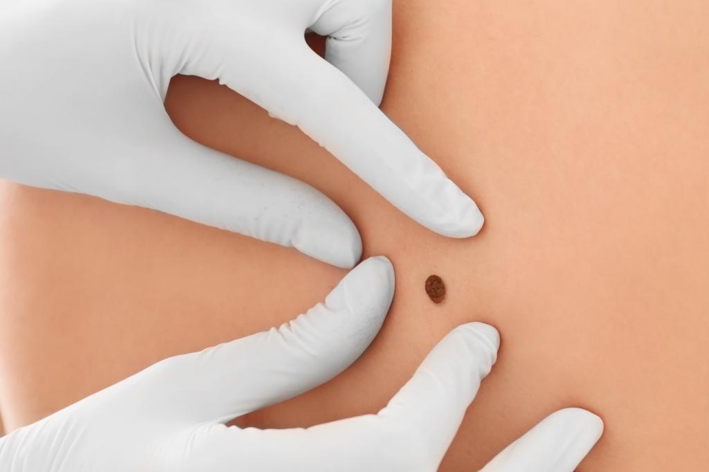 New vaccine prevents deadliest skin cancer from coming back: drugmakers