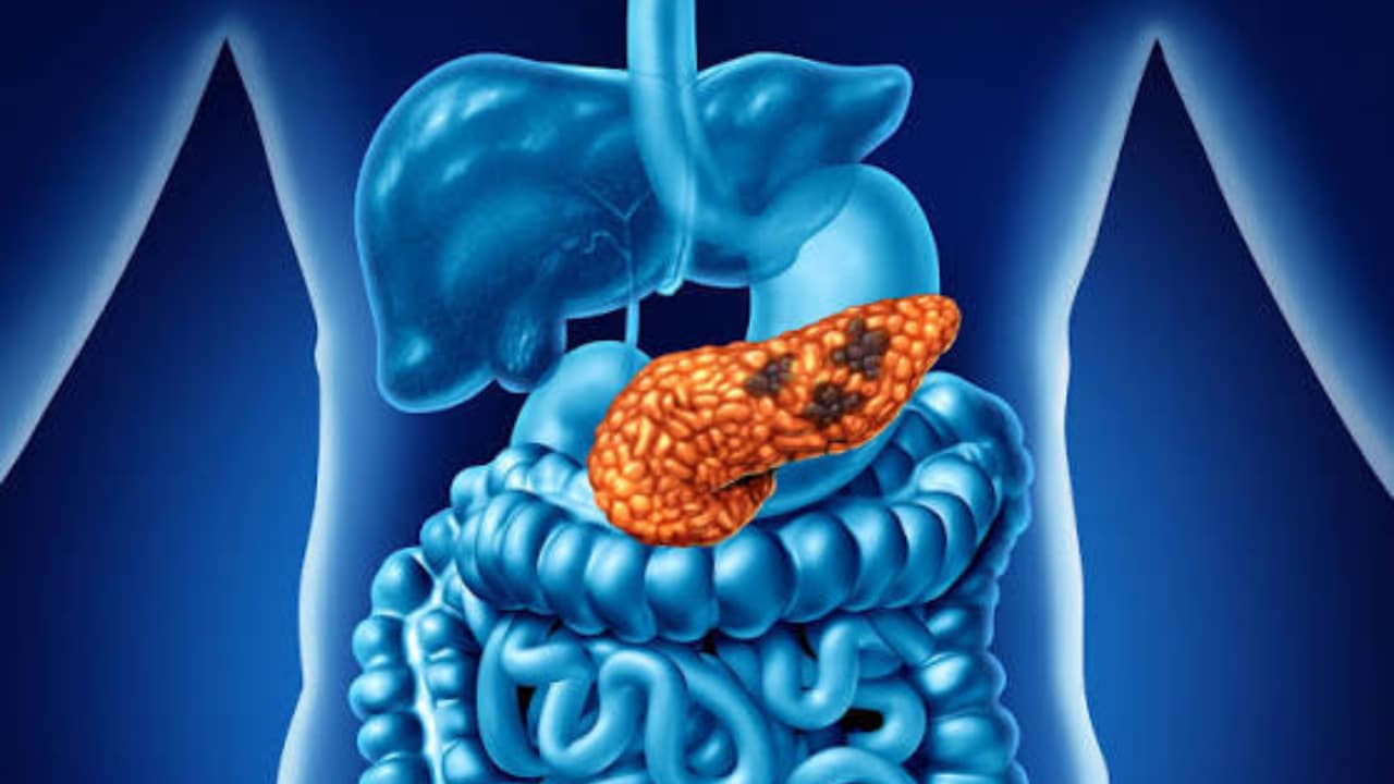 FDA Approves New Pancreatic Cancer Pill