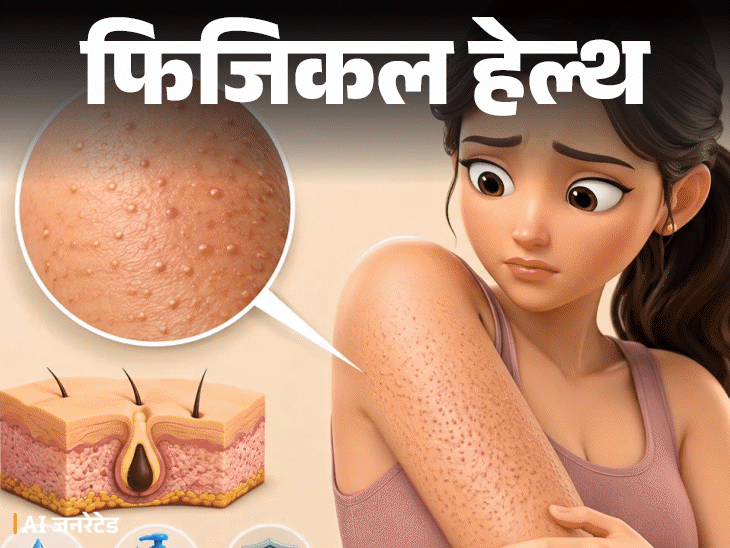 फिजिकल हेल्थ- बांहों पर रेत जैसे बारीक खुरदरे दाने: ये ‘चिकन स्किन’ हो सकती है, डॉक्टर से समझें इसका कारण, इलाज और बचाव के टिप्स1:27Play video