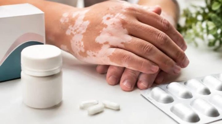 UAE Approves Pill for Vitiligo Treatment
