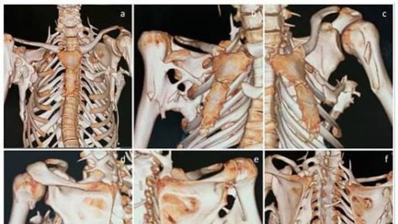 New Drug Offers Treatment Option for Rare Bone Disease