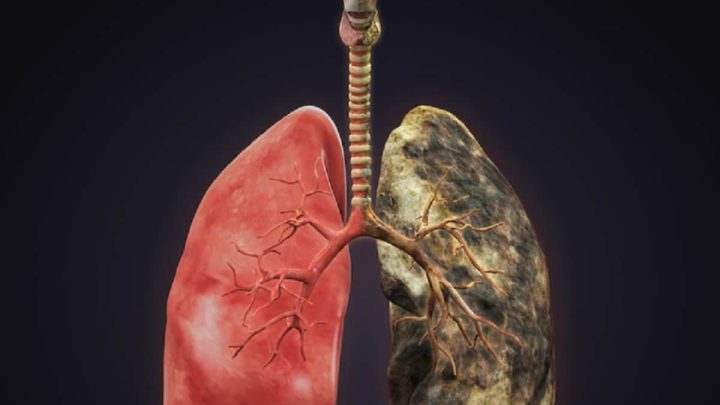 Study Reports Major Trial Success in Lung Cancer