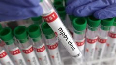 Newborn Tests Positive for Mpox After Circumcision at Karachi Hospital